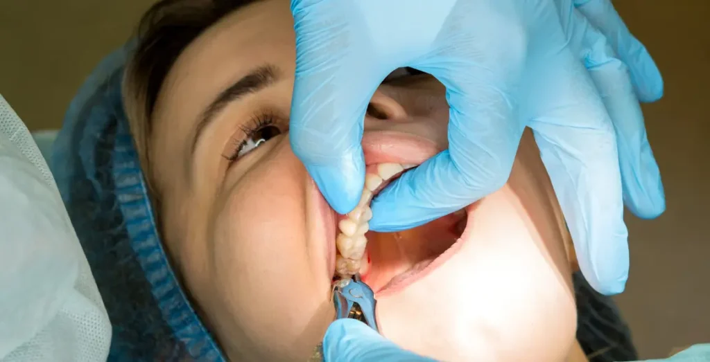 Tooth Extractions in Islamabad
