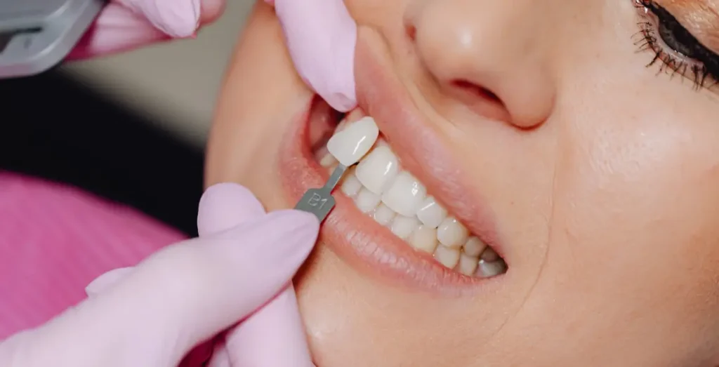 Veneer Placement Islamabad